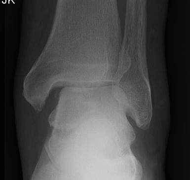 Ankle Fracture Maisonnerve Injury